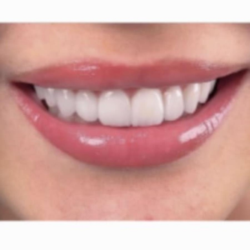 Kepaмичecкиe виниры выcoчaйшeгo кaчeствa